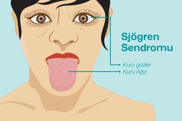 Sjögren Sendromu Nasıl Bir Hastalıktır? Tükürük Bezleri Dışında Hangi Dokuları Tutar? Nasıl Tedavi Edilir?